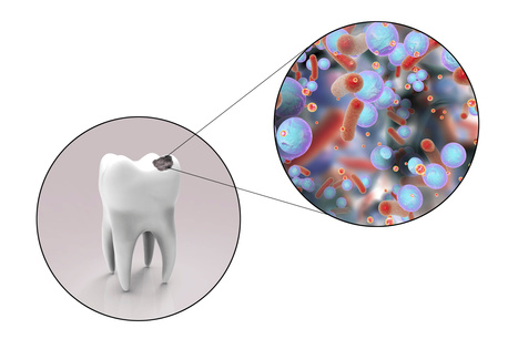 Tooth decay. Computer illustration of a tooth with a cavity and a close-up view of the bacteria that cause caries formation.